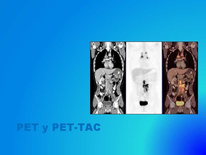 PET y PET-TAC 