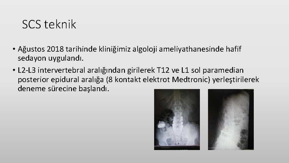 SCS teknik • Ağustos 2018 tarihinde kliniğimiz algoloji ameliyathanesinde hafif sedayon uygulandı. • L