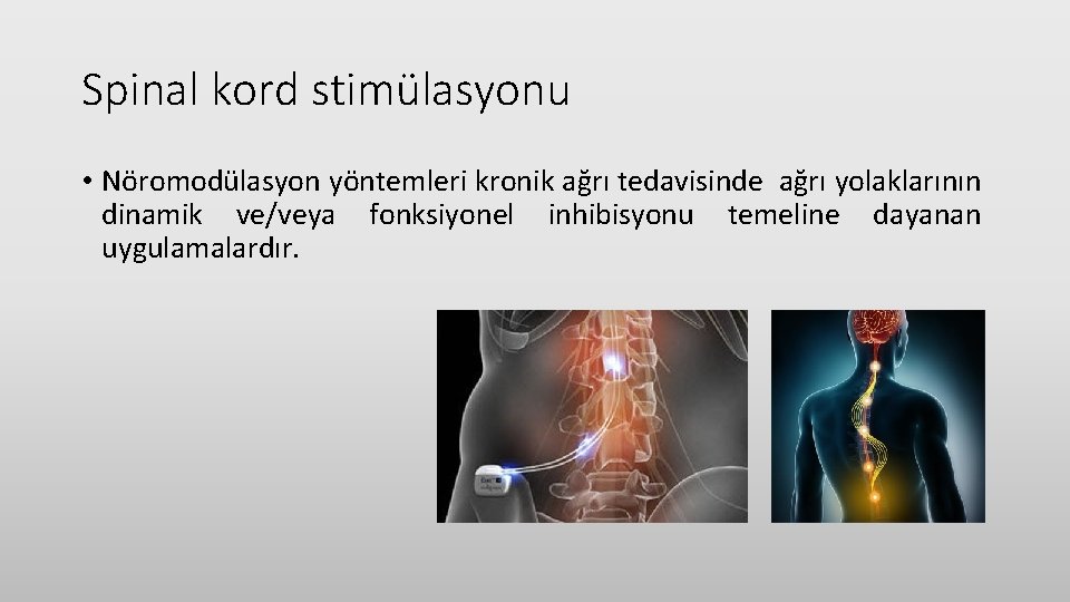 Spinal kord stimülasyonu • Nöromodülasyon yöntemleri kronik ağrı tedavisinde ağrı yolaklarının dinamik ve/veya fonksiyonel