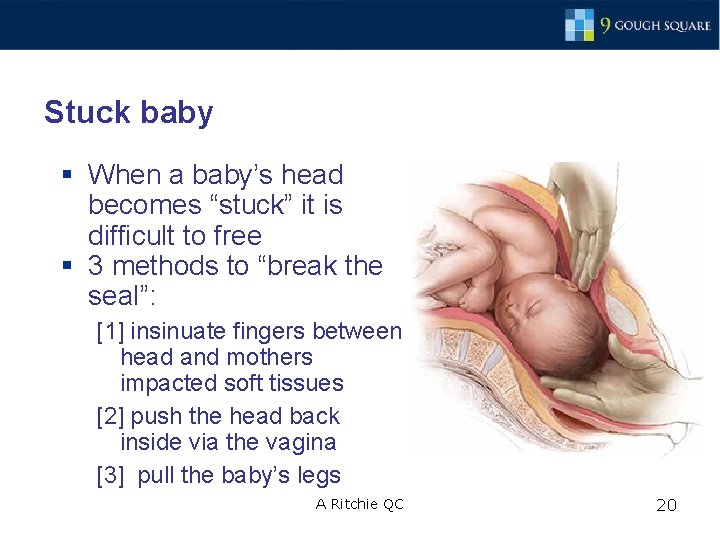 Stuck baby § When a baby’s head becomes “stuck” it is difficult to free
