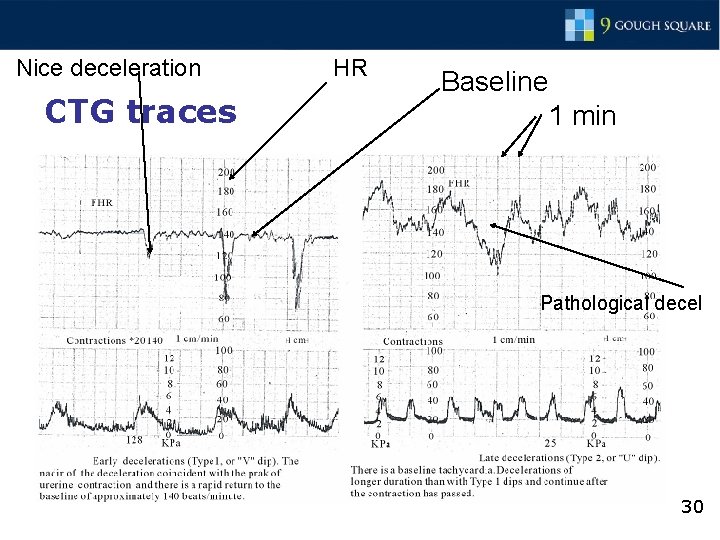 Nice deceleration CTG traces HR Baseline 1 min Pathological decel 30 