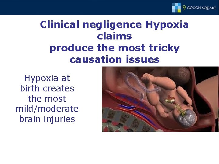 Clinical negligence Hypoxia claims produce the most tricky causation issues Hypoxia at birth creates