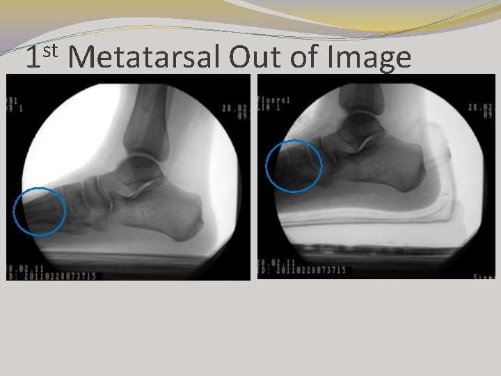 st 1 Metatarsal Out of Image st 1 Metatarsal Out of Image