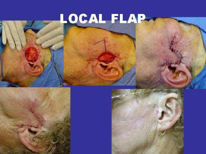 LOCAL FLAP • Local flap- Raised adjacent to a tissue defect in order to