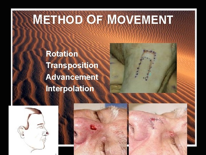METHOD OF MOVEMENT Rotation Transposition Advancement Interpolation 