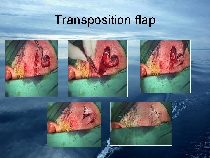 Transposition flap 