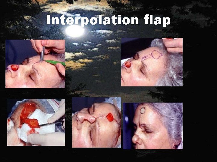 Interpolation flap 