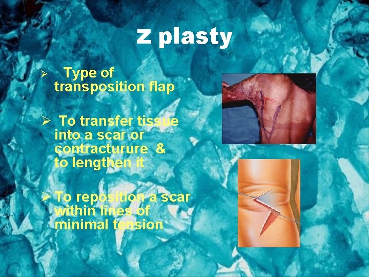 z plasty Ø Type of transposition flap Ø To transfer tissue into a scar