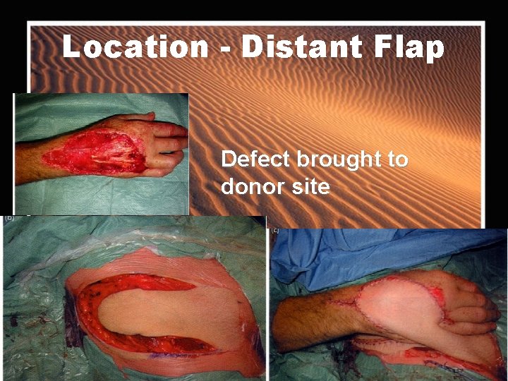 Location - Distant Flap Defect brought to donor site 
