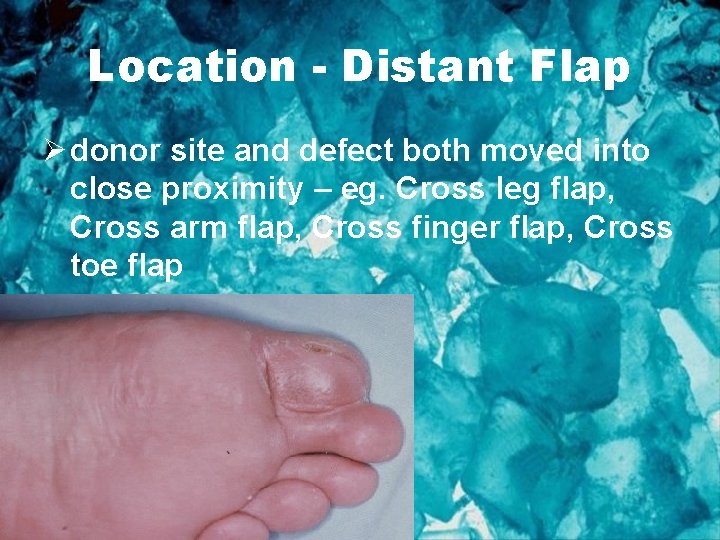 Location - Distant Flap Ø donor site and defect both moved into close proximity