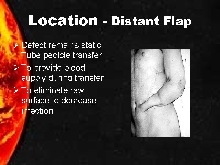 Location - Distant Flap Ø Defect remains static. Tube pedicle transfer Ø To provide