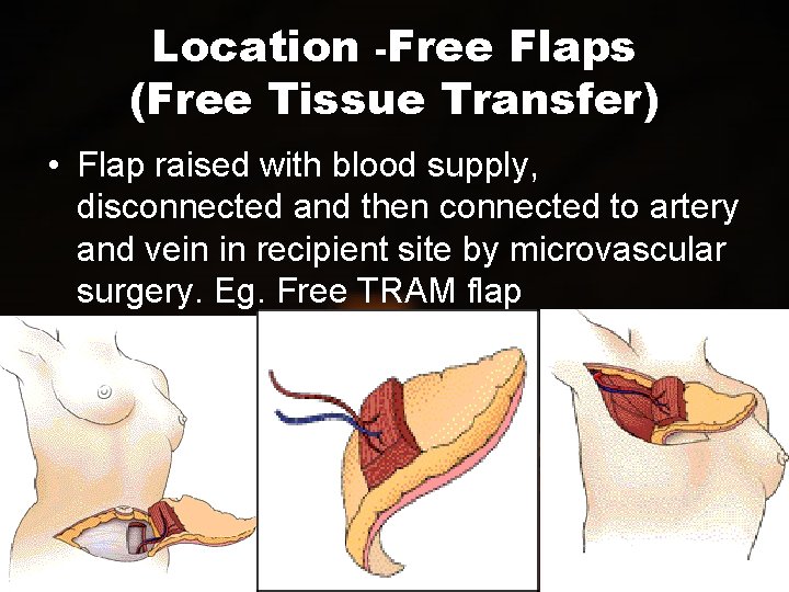 Location -Free Flaps (Free Tissue Transfer) • Flap raised with blood supply, disconnected and