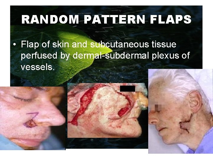 RANDOM PATTERN FLAPS • Flap of skin and subcutaneous tissue perfused by dermal-subdermal plexus