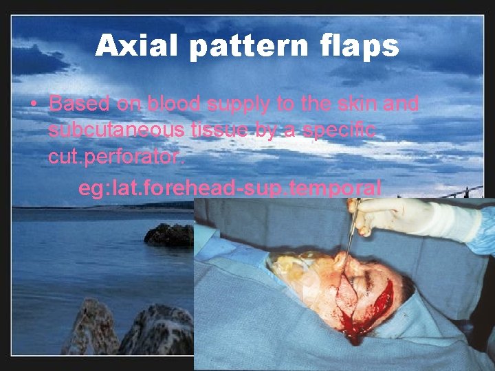 Axial pattern flaps • Based on blood supply to the skin and subcutaneous tissue