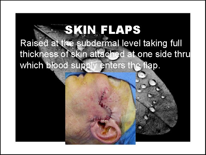 SKIN FLAPS • Raised at the subdermal level taking full thickness of skin attached