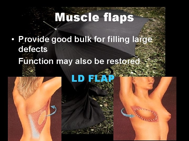 Muscle flaps • Provide good bulk for filling large defects Function may also be