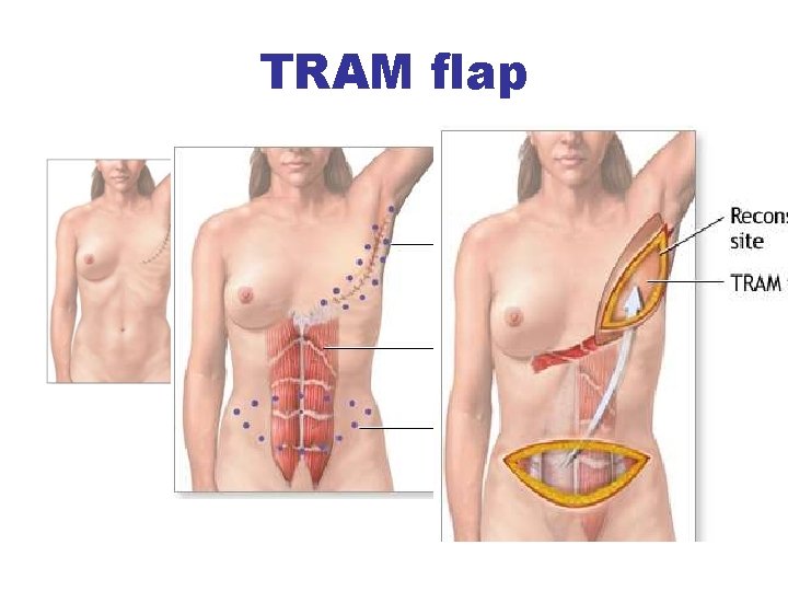 TRAM flap 