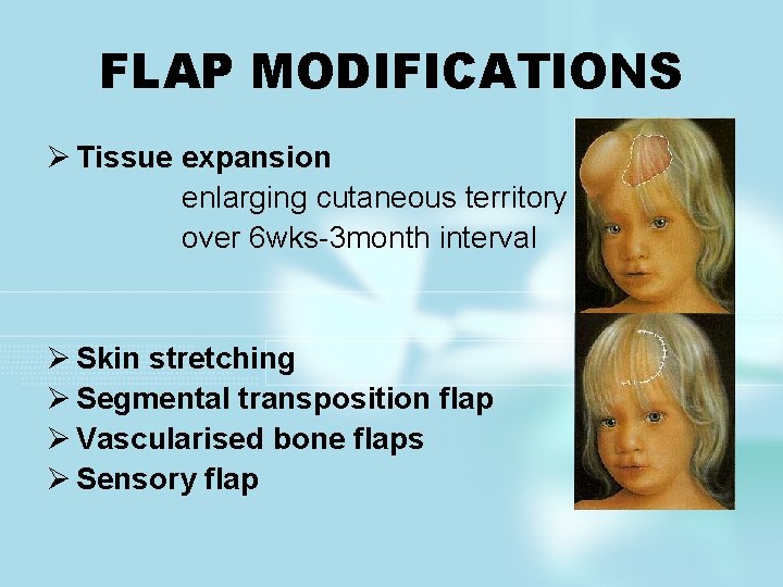 FLAP MODIFICATIONS Ø Tissue expansion enlarging cutaneous territory over 6 wks-3 month interval Ø