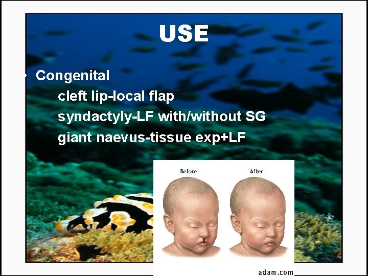 USE • Congenital cleft lip-local flap syndactyly-LF with/without SG giant naevus-tissue exp+LF 