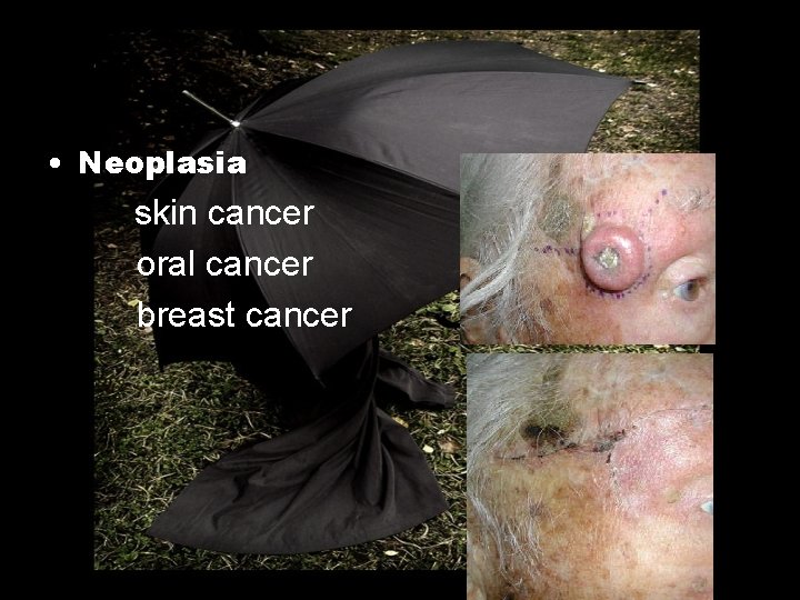  • Neoplasia skin cancer oral cancer breast cancer 