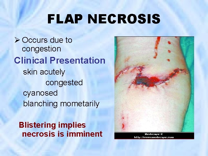 FLAP NECROSIS Ø Occurs due to congestion Clinical Presentation skin acutely congested cyanosed blanching