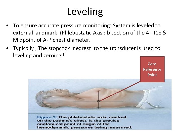 Leveling • To ensure accurate pressure monitoring: System is leveled to external landmark (Phlebostatic