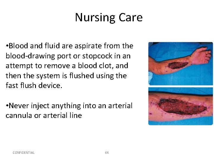 Nursing Care • Blood and fluid are aspirate from the blood-drawing port or stopcock