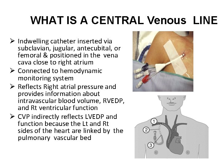 WHAT IS A CENTRAL Venous LINE Ø Indwelling catheter inserted via subclavian, jugular, antecubital,