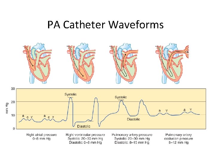 PA Catheter Waveforms 