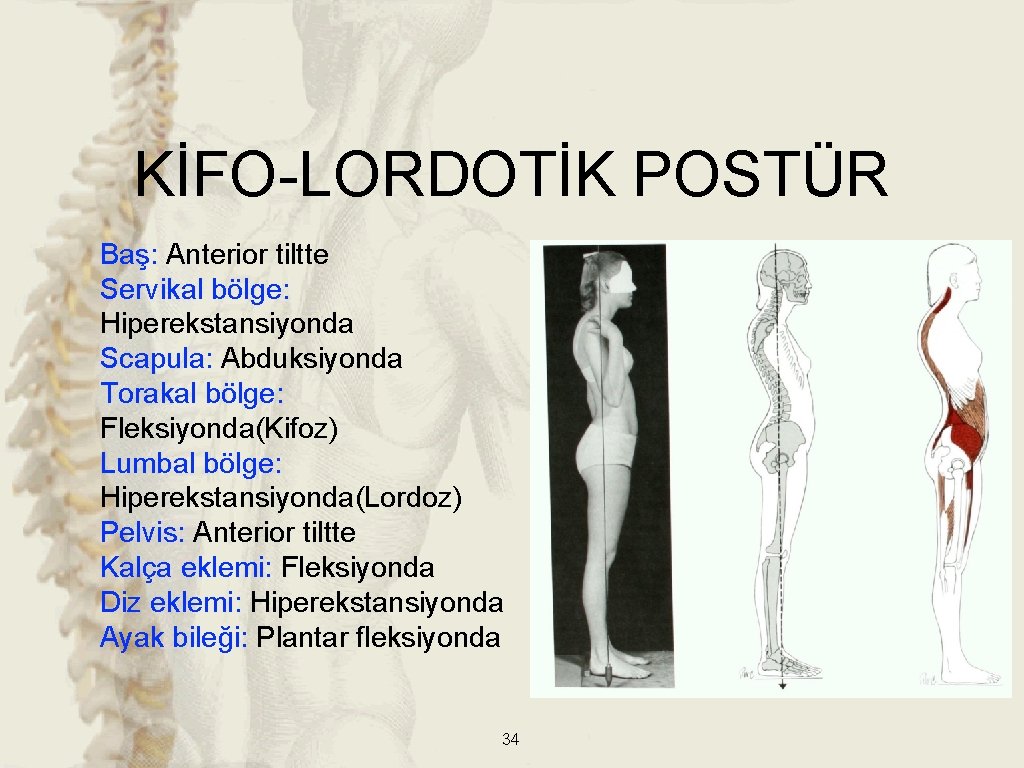 KİFO-LORDOTİK POSTÜR Baş: Anterior tiltte Servikal bölge: Hiperekstansiyonda Scapula: Abduksiyonda Torakal bölge: Fleksiyonda(Kifoz) Lumbal KİFO-LORDOTİK POSTÜR Baş: Anterior tiltte Servikal bölge: Hiperekstansiyonda Scapula: Abduksiyonda Torakal bölge: Fleksiyonda(Kifoz) Lumbal