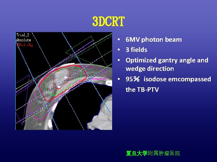 3 DCRT • 6 MV photon beam • 3 fields • Optimized gantry angle