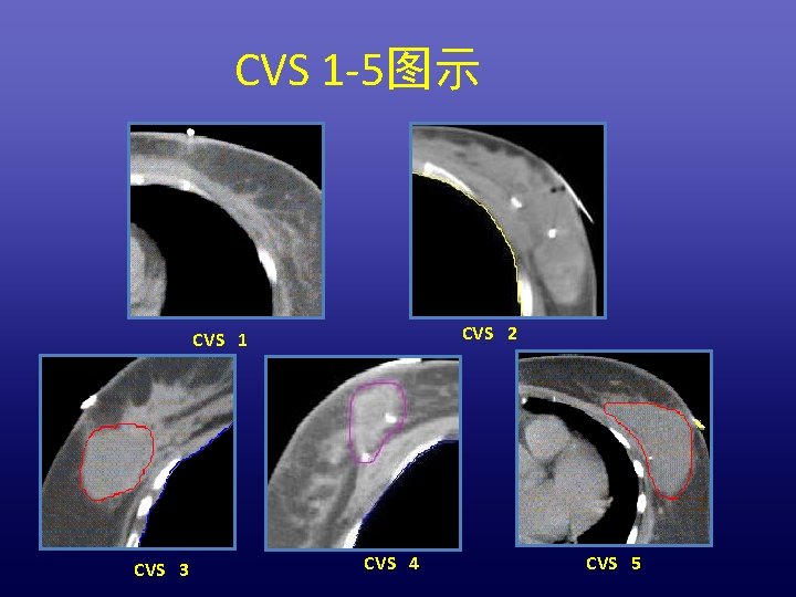 CVS 1 -5图示 CVS 2 CVS 1 CVS 3 CVS 4 CVS 5 