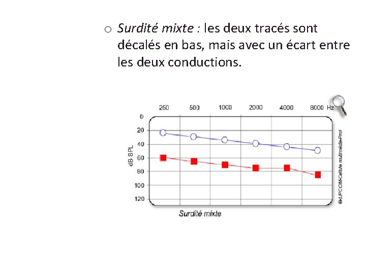 o Surdité mixte : les deux tracés sont décalés en bas, mais avec un