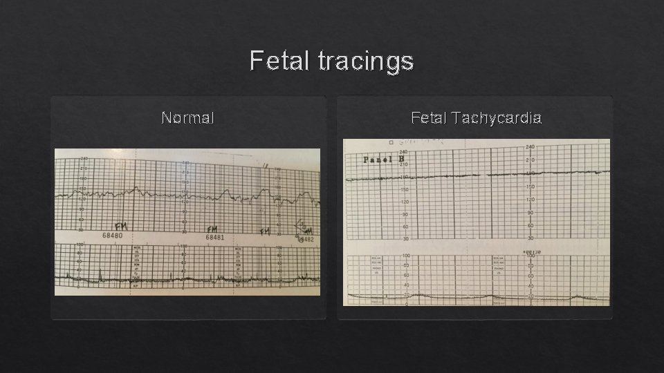 Fetal tracings Normal Fetal Tachycardia 