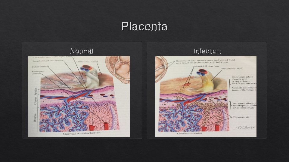 Placenta Normal Infection 