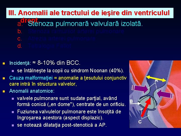 III. Anomalii ale tractului de ieşire din ventriculul a. drept. Stenoza pulmonară valvulară izolată.