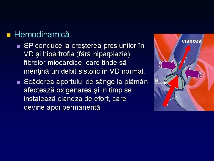 n Hemodinamică: n n SP conduce la creşterea presiunilor în VD şi hipertrofia (fără