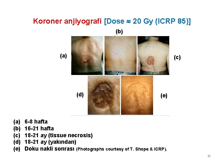 Koroner anjiyografi [Dose 20 Gy (ICRP 85)] (b) (a) (c) (d) (e) (a) 6