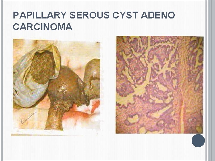 PAPILLARY SEROUS CYST ADENO CARCINOMA 