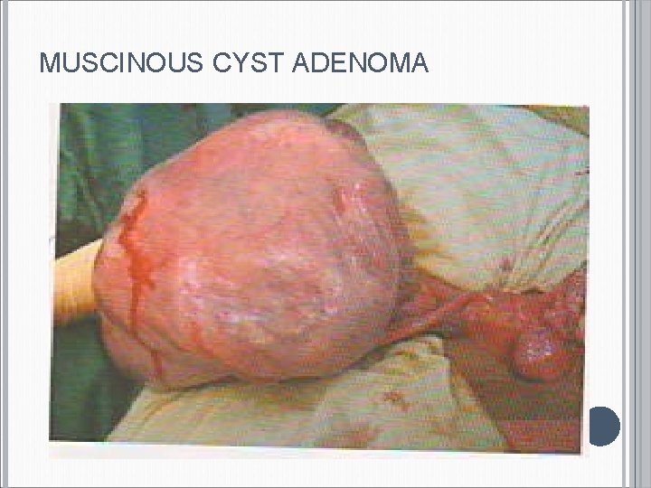 MUSCINOUS CYST ADENOMA 