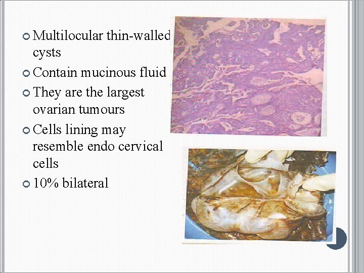  Multilocular thin-walled cysts Contain mucinous fluid They are the largest ovarian tumours Cells