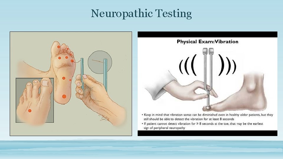 Neuropathic Testing 