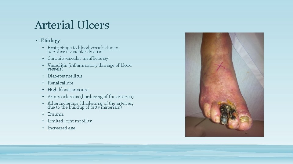 Arterial Ulcers • Etiology • Restrictions to blood vessels due to peripheral vascular disease