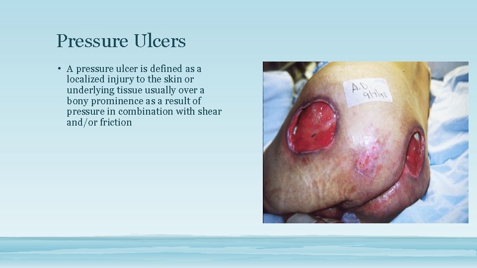 Pressure Ulcers • A pressure ulcer is defined as a localized injury to the