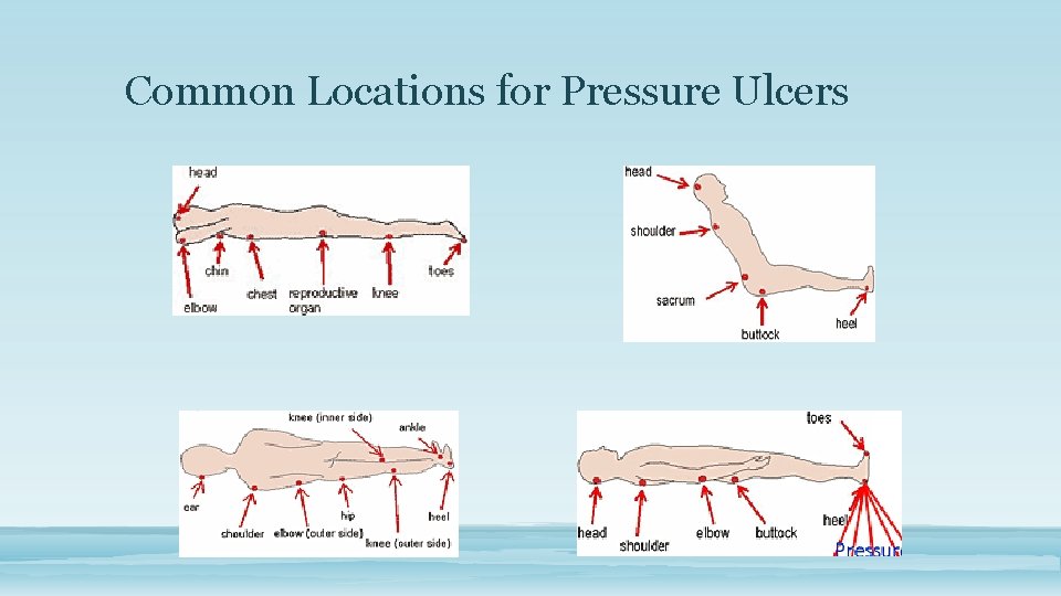 Common Locations for Pressure Ulcers 