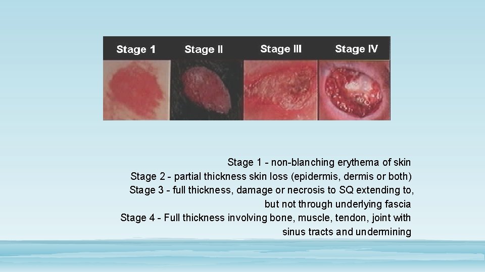 Stage 1 - non-blanching erythema of skin Stage 2 - partial thickness skin loss