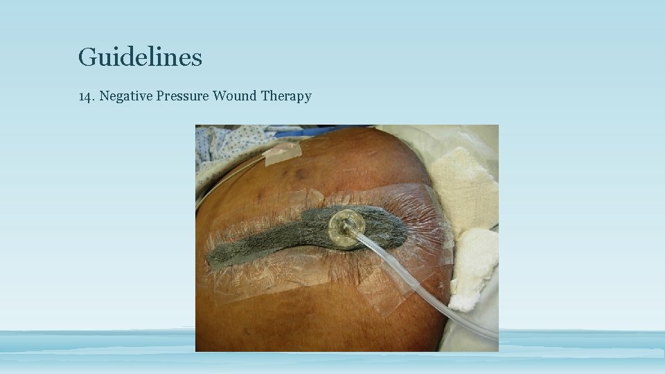 Guidelines 14. Negative Pressure Wound Therapy 