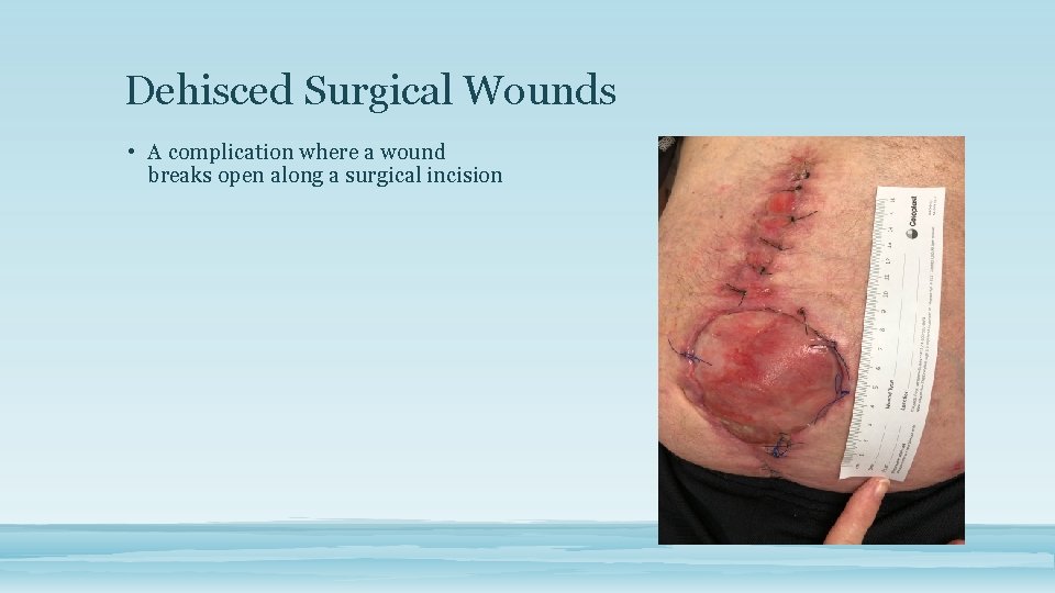 Dehisced Surgical Wounds • A complication where a wound breaks open along a surgical