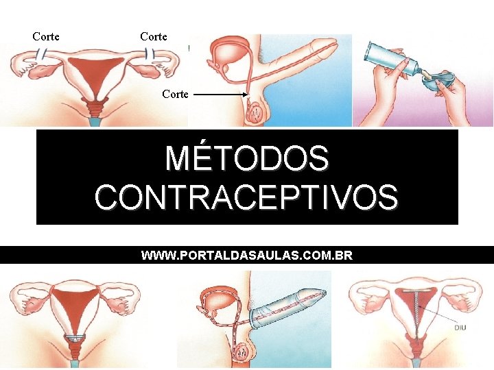 Corte MÉTODOS CONTRACEPTIVOS WWW. PORTALDASAULAS. COM. BR 