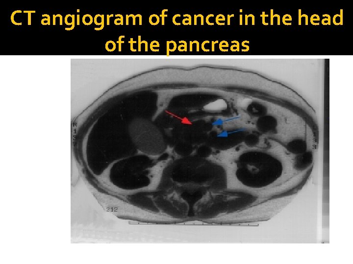 CT angiogram of cancer in the head of the pancreas 